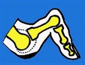 -	stade 3 : subluxation dorsale du deuxième orteil au dessus du pied